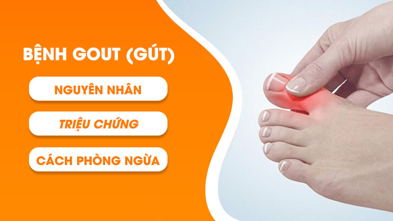 GOUT (GÚT) bệnh lý nghiêm trọng | Nguyên nhân, triệu chứng, cách phòng tránh