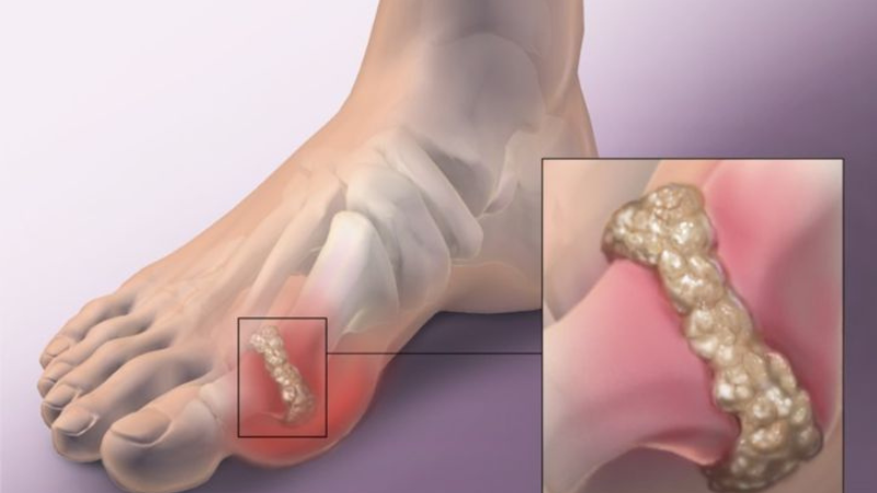 GOUT (GÚT) bệnh lý nghiêm trọng | Nguyên nhân, triệu chứng, cách phòng tránh