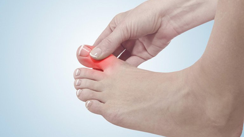 GOUT (GÚT) bệnh lý nghiêm trọng | Nguyên nhân, triệu chứng, cách phòng tránh