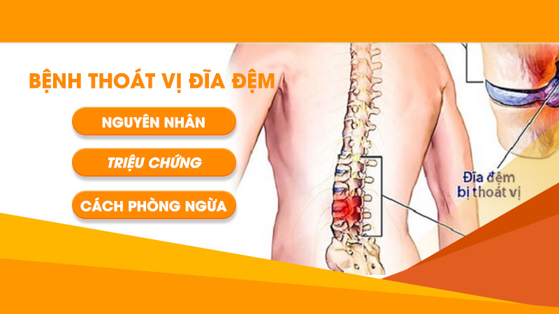 Bệnh thoát vị đĩa đệm | Nguyên nhân, triệu chứng, Cách phòng ngừa hiệu quả nhất